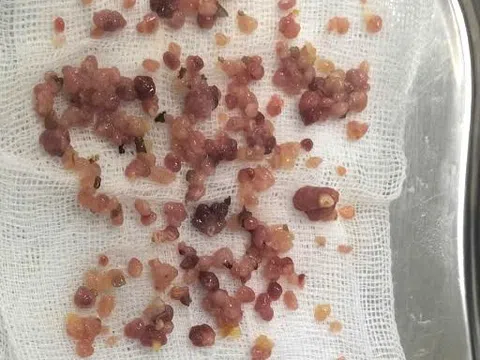 Bác sĩ sốc phát hiện hàng trăm polyp đại tràng khi nội soi