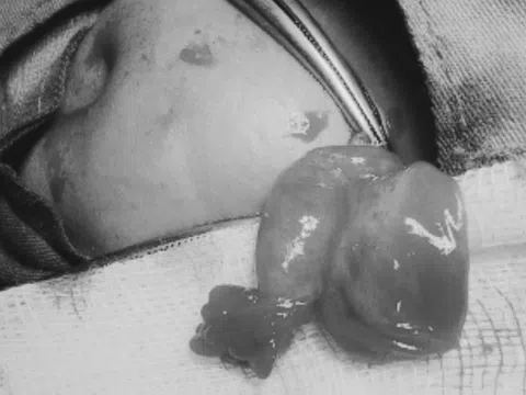 Một trường hợp cảnh báo từ bé gái 11 tháng tuổi