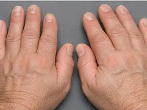 Bỗng dưng bàn tay, bàn chân to ra: Có thể là dấu hiệu bệnh lý nguy hiểm