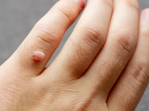 Đường lây truyền của virus HPV