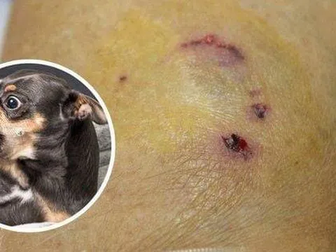 Bốn người trong gia đình bị chó cắn nhưng không tiêm phòng, một người tử vong