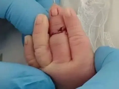 Nữ y tá vô tình cắt đứt ngón tay trẻ sơ sinh khi cắt dây rốn