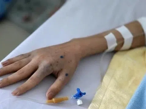 Ung thư dạ dày ngày càng nhiều: BS lưu ý thói quen xấu của người trẻ