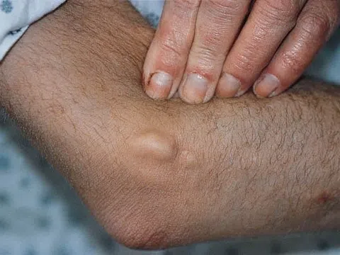 Người đàn ông có dấu hiệu suy thận nhiều năm nhưng không biết