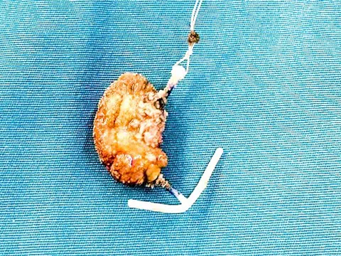 Lấy được vòng tránh thai nhiều sỏi bám do ‘đi lạc’ vào bàng quang sau 22 năm đặt