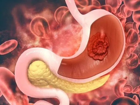 Ung thư dạ dày nguy hiểm và diễn biến nhanh: Ai có nguy cơ mắc?