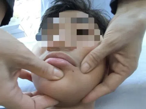 Nhiều người nhập viện vì méo miệng, mắt trái không nhắm kín