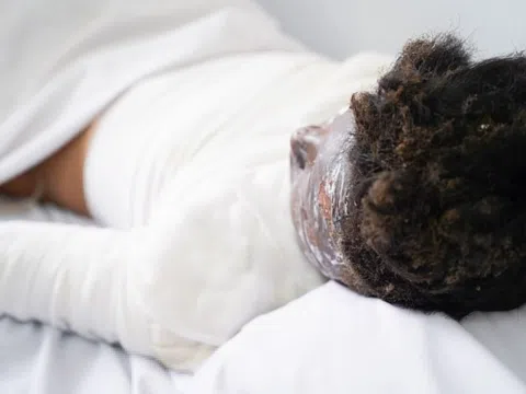 Trò vui khiến bé trai bỏng thương tâm toàn bộ mặt