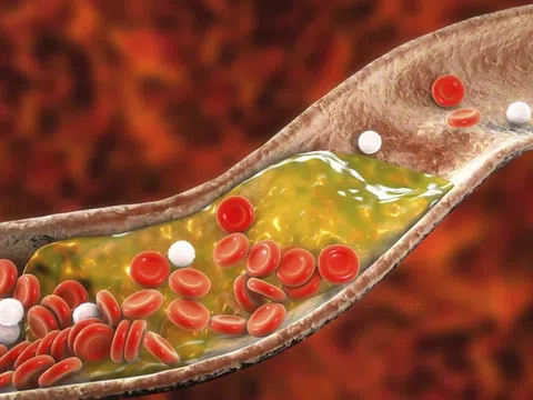 Công dụng tuyệt vời của dưa chuột với mỡ máu cao