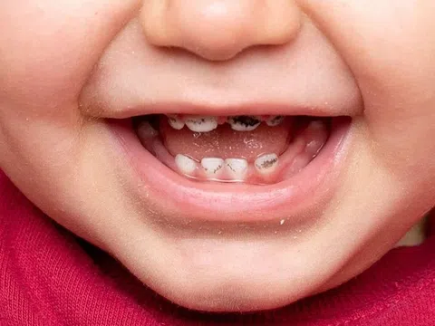 Sâu răng sữa có cần điều trị không?