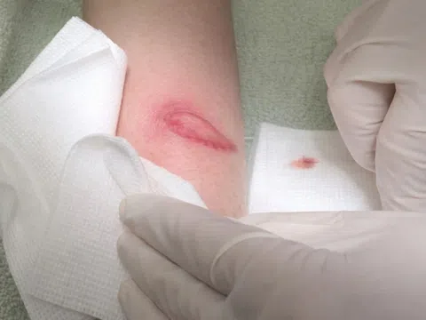 Gánh hậu quả đau lòng vì nôn nóng tiêm filler vòng ba