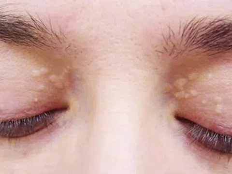 Triệu chứng mỡ máu ở mức nguy hiểm xuất hiện trên da