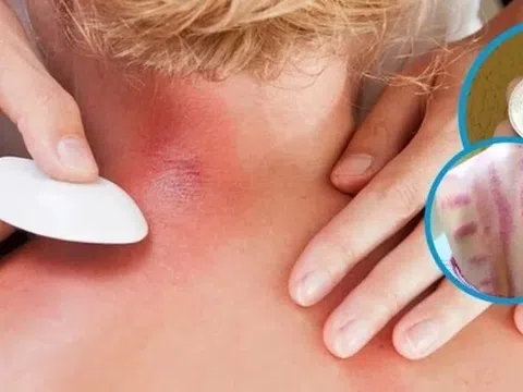 Vì sao đau mỏi người, 'trúng gió' dùng đồ bạc, trứng gà để cạo gió?