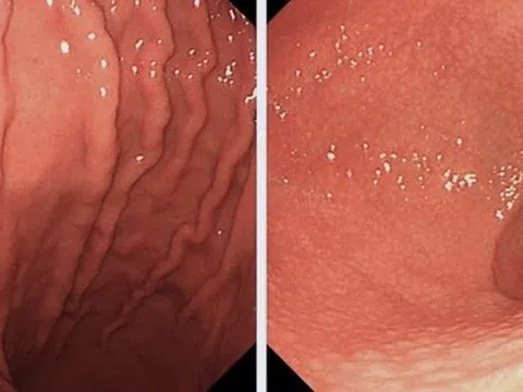 Thói quen ăn uống khiến cả gia đình cùng nhiễm HP dạ dày