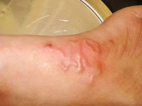 Ngứa toàn thân suốt 1 năm, người đàn ông bất ngờ khi biết lý do