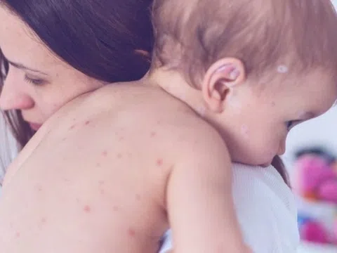 Trẻ bị thủy đậu ăn gì để nhanh khỏi?