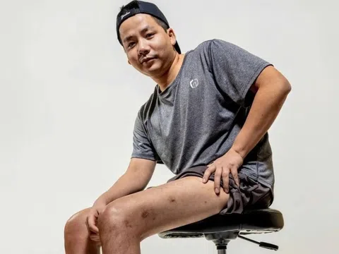 Cú trượt dài của Khoa Pug sau 2 lần mổ kéo chân để cao 1m80