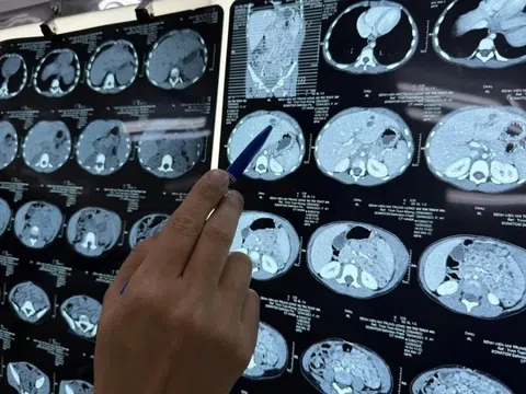 Điều gì xảy ra khi nhiễm giun sán, lâu ngày không xổ?