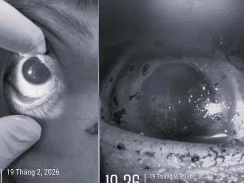 Sau tiếng nổ lớn ngoài sân, người phụ nữ mất vĩnh viễn nhãn cầu