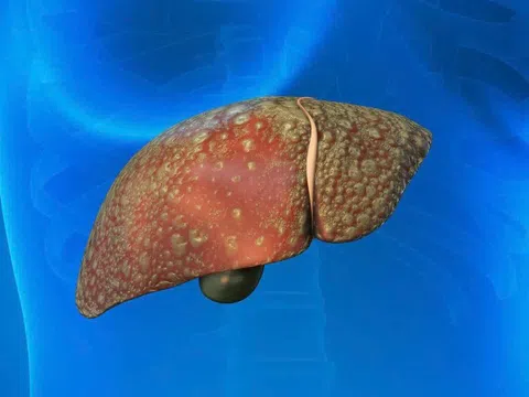 Bệnh gan tăng vọt sau Tết: Bác sĩ nêu thói quen đang 'bức tử' nội tạng