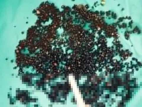 Thói xấu khó bỏ, người đàn ông mang 5.000 viên sỏi trong túi mật