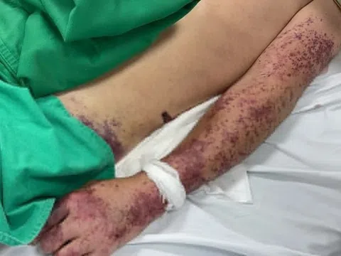 Bệnh liên cầu lợn là gì?