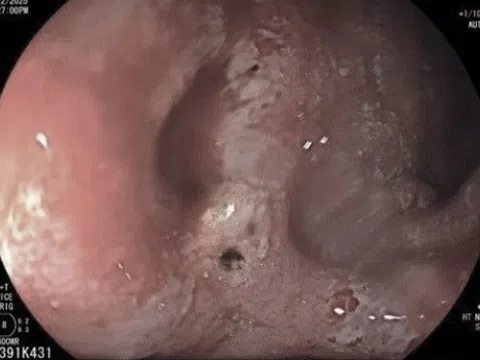 Một thói quen 'tự hủy' dạ dày rất nhiều người trẻ mắc