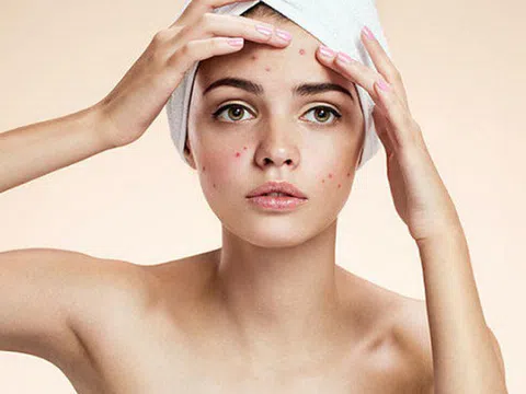 Giải đáp thắc mắc “vạn người hỏi” Acnes trị mụn có tốt không?