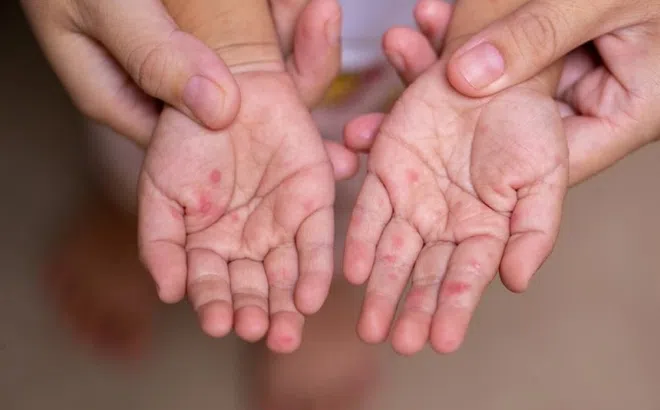 Cách chăm sóc trẻ nhỏ bị mắc sởi