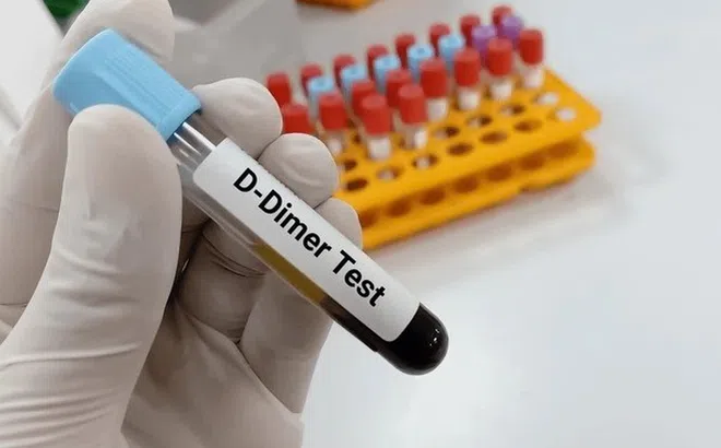 Hai tình huống nếu có cục máu đông sau tiêm vaccine Covid-19