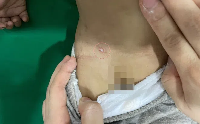 Vết đốt gây nguy hiểm cho bé 15 tháng tuổi