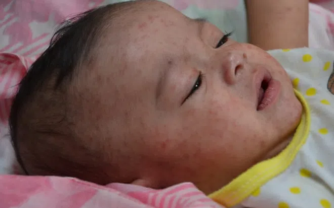 Nguy cơ sốt xuất huyết ở TP.HCM khi mùa mưa đến