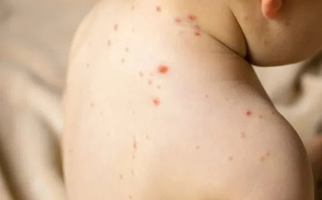 TP.HCM ghi nhận thêm 2 ca bệnh sởi