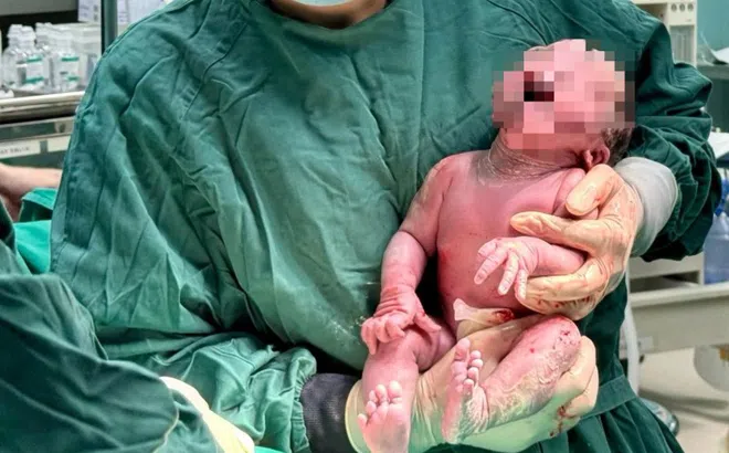 Người mẹ cao 1,3 mét sinh bé gái nặng 3,5 kg