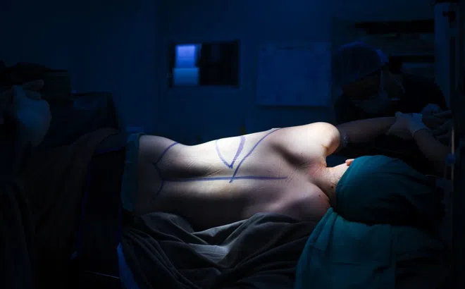 Cảnh bác sĩ 'biến hóa' cơ lưng làm ngực cho nữ bệnh nhân