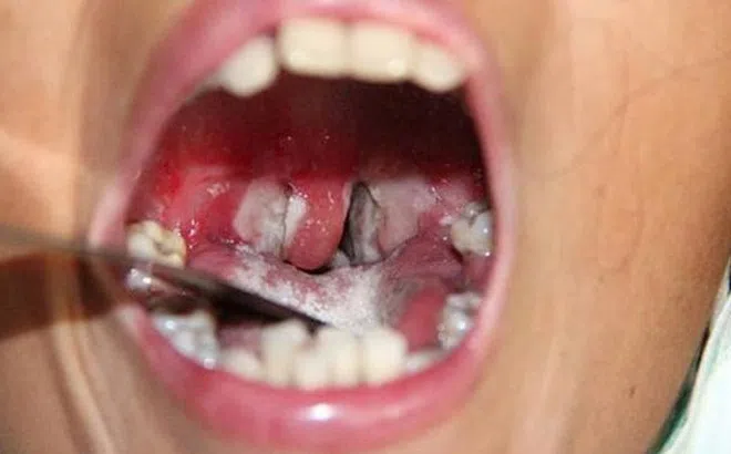 Chăm sóc trẻ bị bệnh bạch hầu