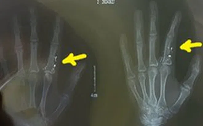 Nhiệt kế vỡ: Nguy hiểm nhiễm độc thủy ngân, nguy cơ lớn nếu dùng máy hút bụi dọn