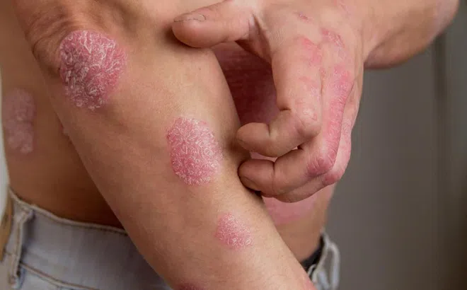 Căn bệnh khiến da chàng trai bong tróc, sần sùi như gỗ