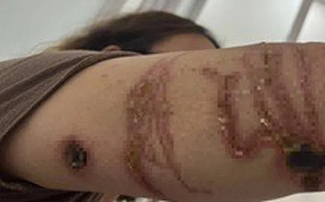 Cảnh báo nhiều người dân bị sứa biển 'tấn công' trong mùa hè