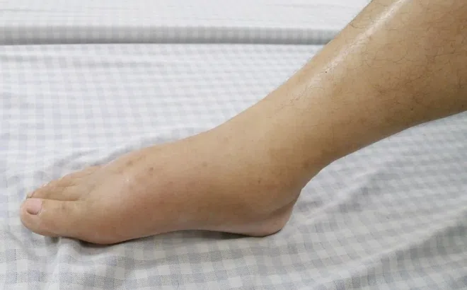 Thận hư mức độ nặng ở tuổi 30 vì điều trị sai lầm