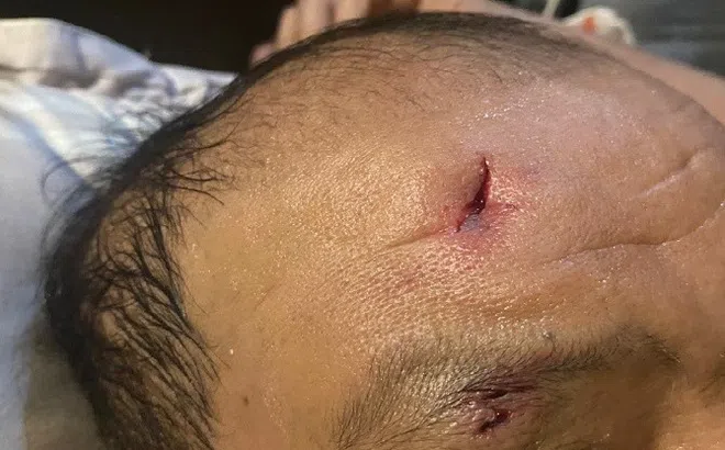 Chó dại nặng 15 kg tấn công nhiều người ở Hà Nội