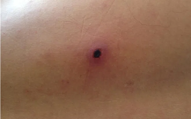 Phát hiện bệnh nguy hiểm từ vết loét nhỏ