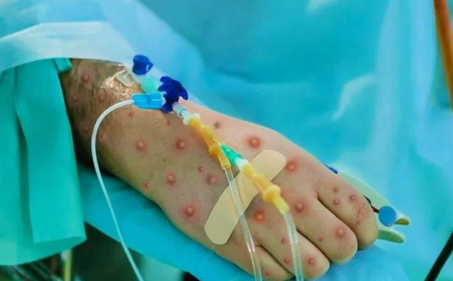WHO cân nhắc ban bố tình trạng khẩn cấp về đậu mùa khỉ