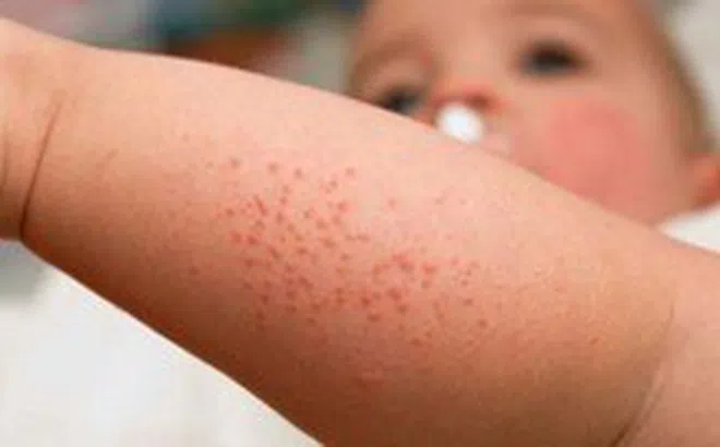 TP.HCM: 60 ca sốt phát ban trong tuần, nghi bệnh sởi
