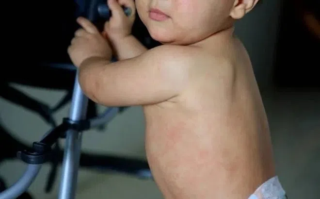 Những dấu hiệu sớm của sởi không nên bỏ qua