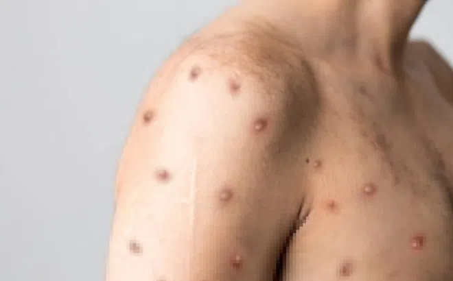 Đậu mùa khỉ vẫn tiếp tục lan rộng