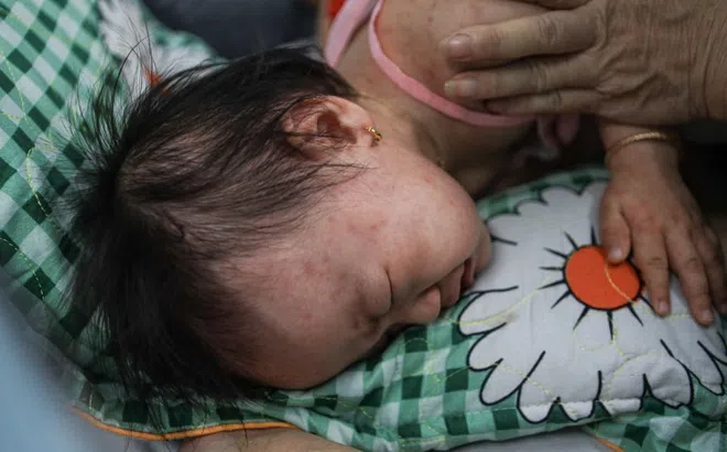 TP.HCM công bố dịch sởi