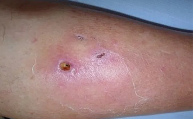 Đồng Nai phát hiện ca nhiễm vi khuẩn 'ăn thịt người'