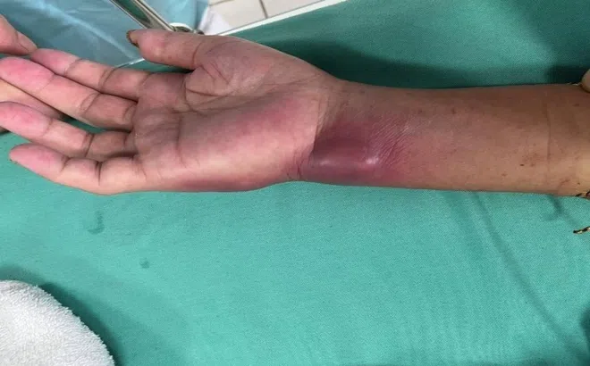 Cổ tay sưng húp, áp xe của bệnh nhân nhiễm vi khuẩn 'ăn thịt người'