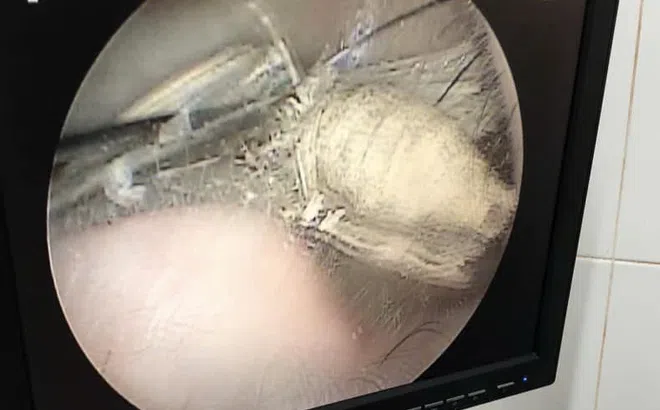 Ù tai, nghe kém do con bọ dài 3cm sống trong tai